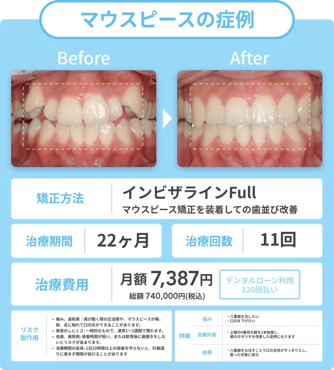 マウスピースの症例