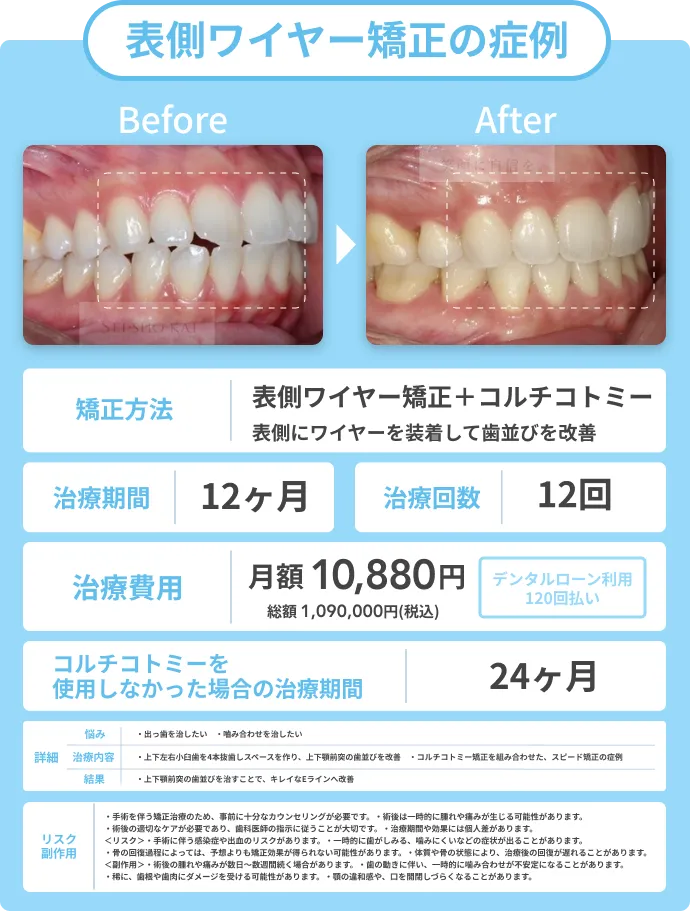 表側ワイヤー矯正の症例