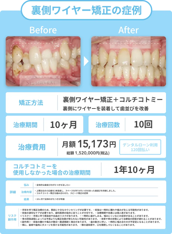 裏側ワイヤー矯正の症例