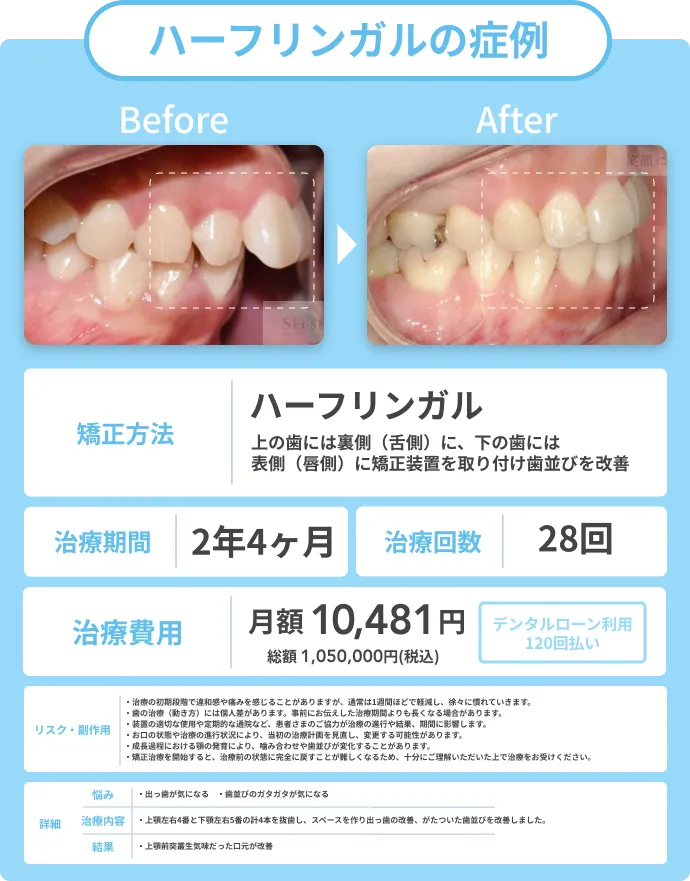 ハーフリンガル矯正の症例