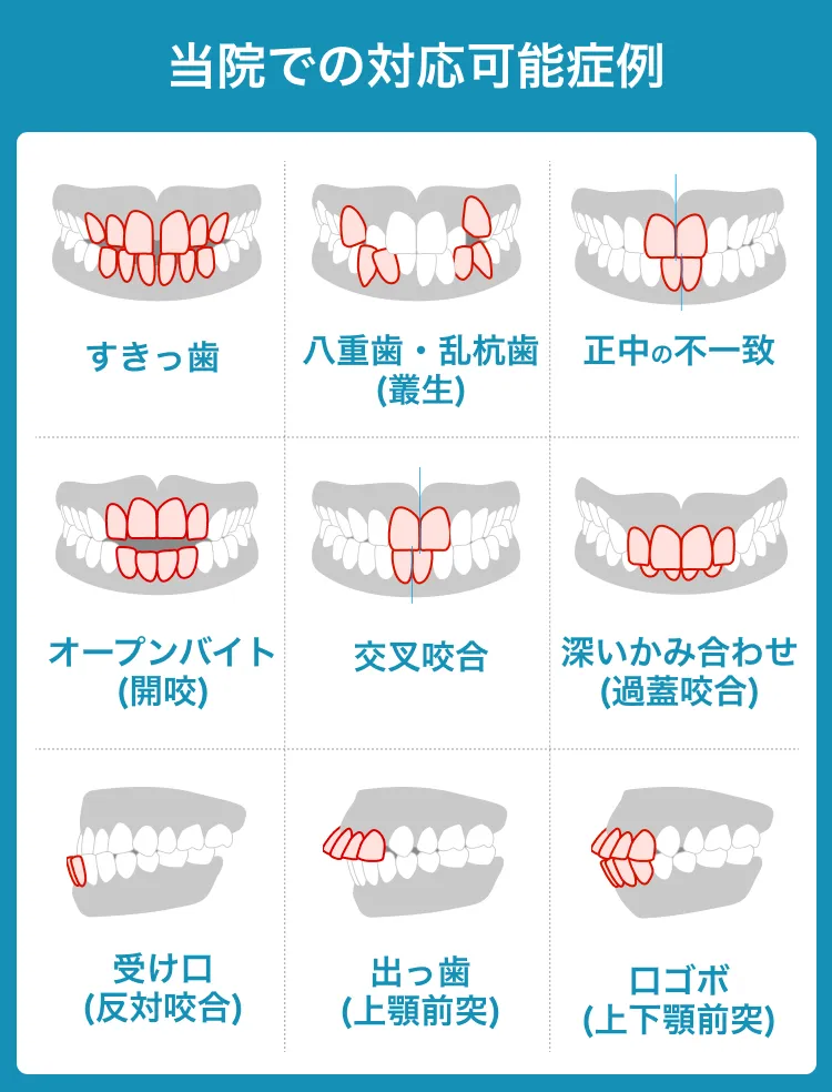 当院での対応可能症例。すきっ歯、八重歯・乱杭歯、正中の不一致、オープンバイト、交叉咬合、深いかみ合わせ、受け口、出っ歯、口ゴボ