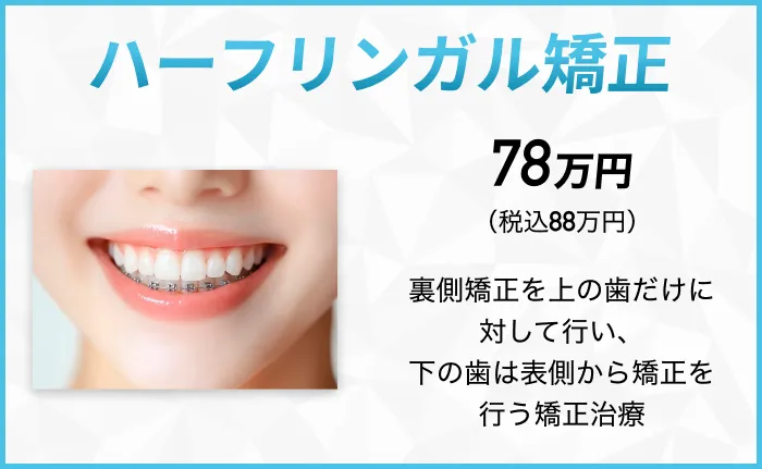 ハーフリンガル矯正 裏側矯正を上の歯だけに対して行い、下の歯は表側から矯正を行う矯正治療