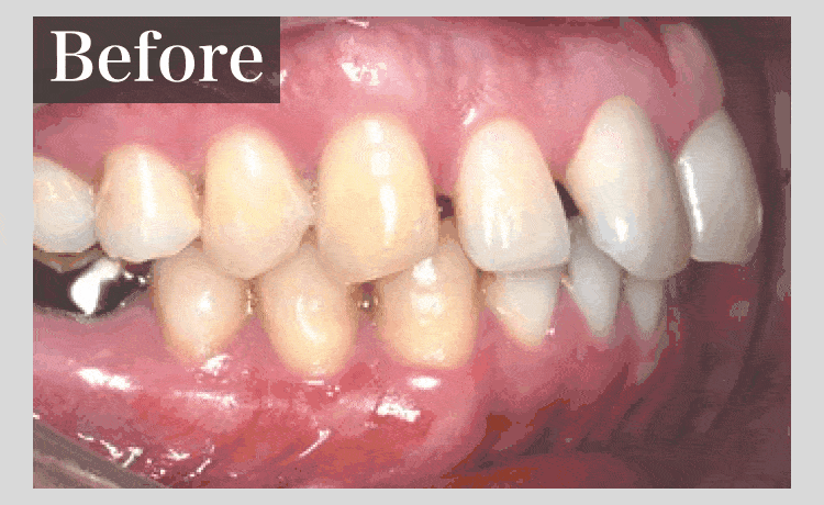 矯正治療ビフォーアフター