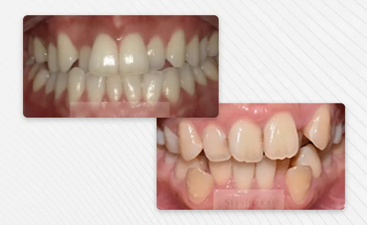 重度の受け口や出っ歯の症例画像