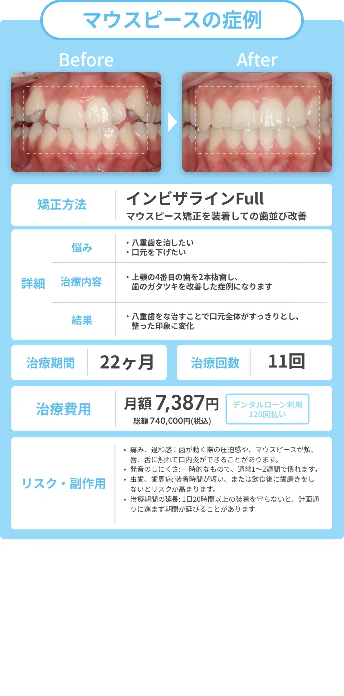 マウスピース矯正の症例