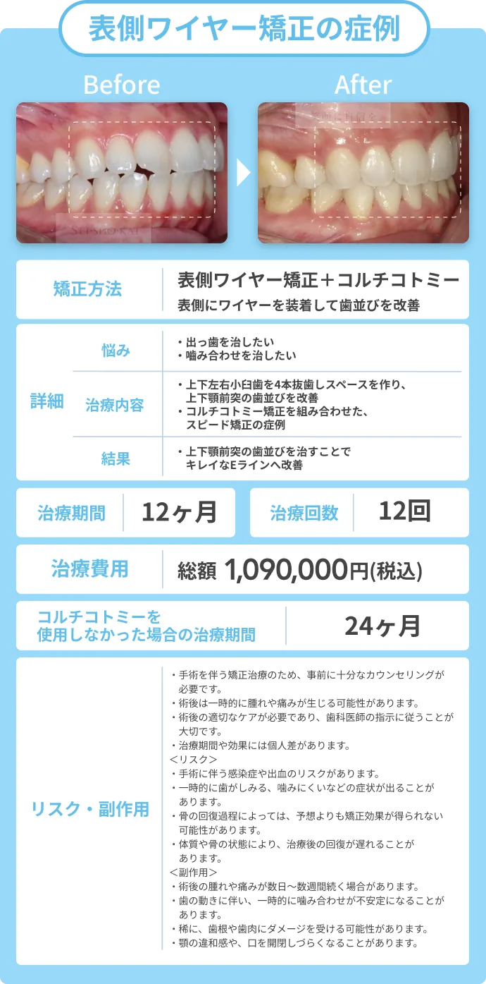 表側ワイヤー矯正の症例