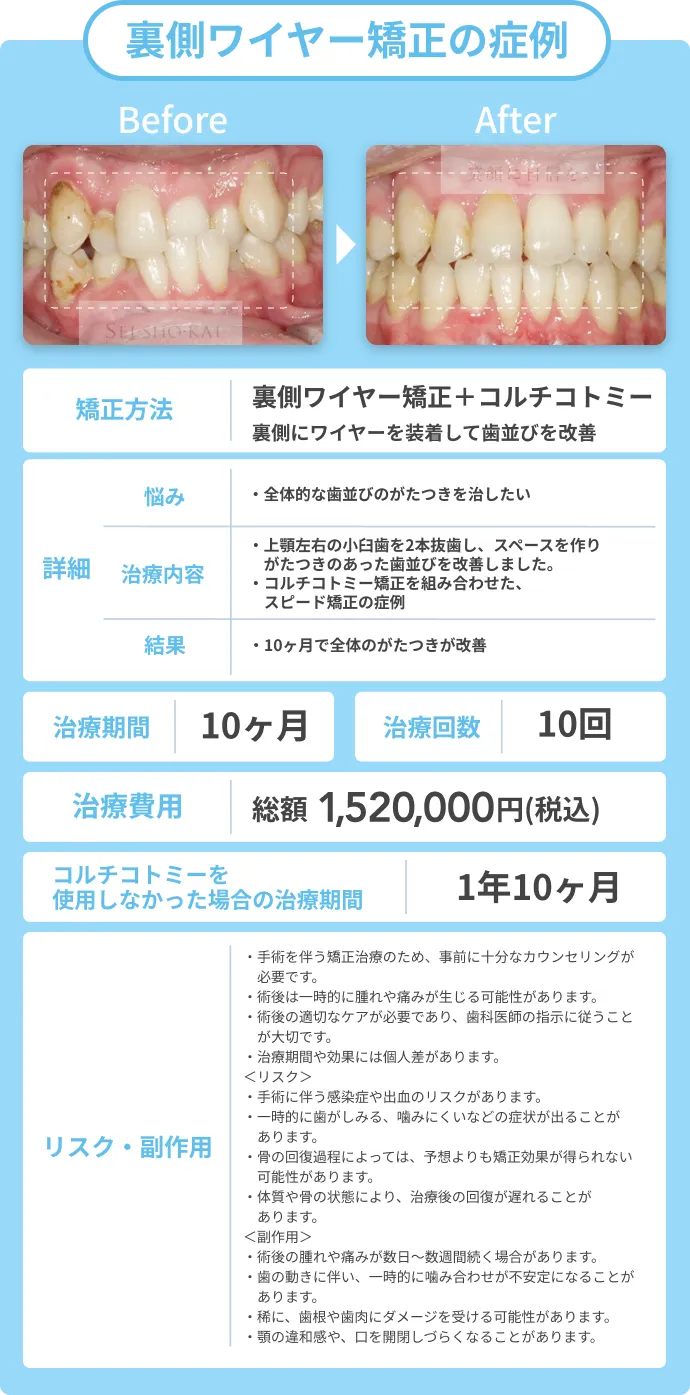 裏側ワイヤー矯正の症例