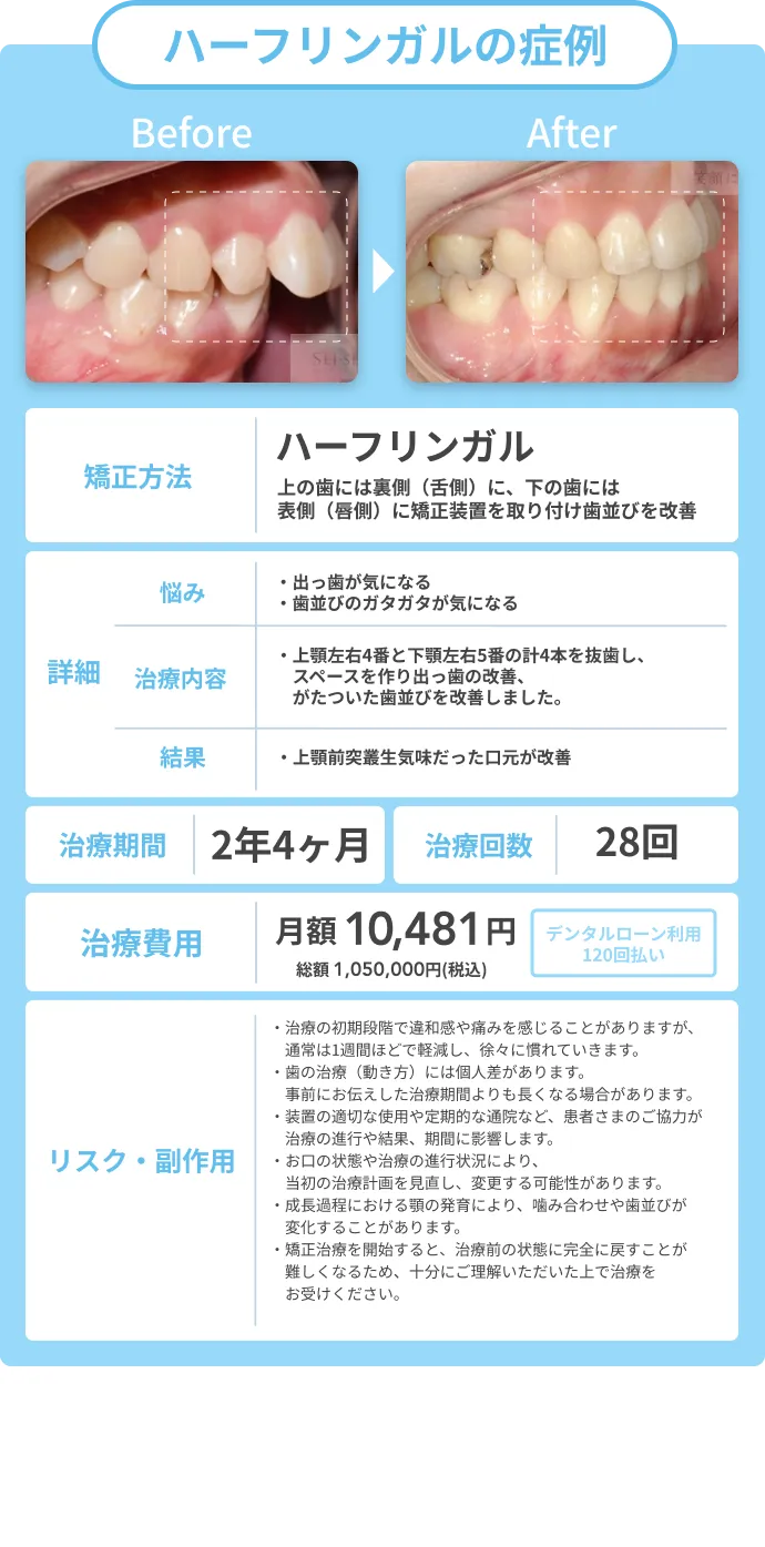 ハーフリンガル矯正の症例