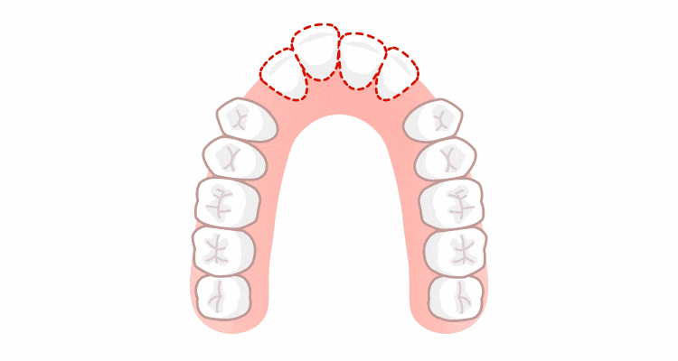 抜歯をして歯並びが整う様子