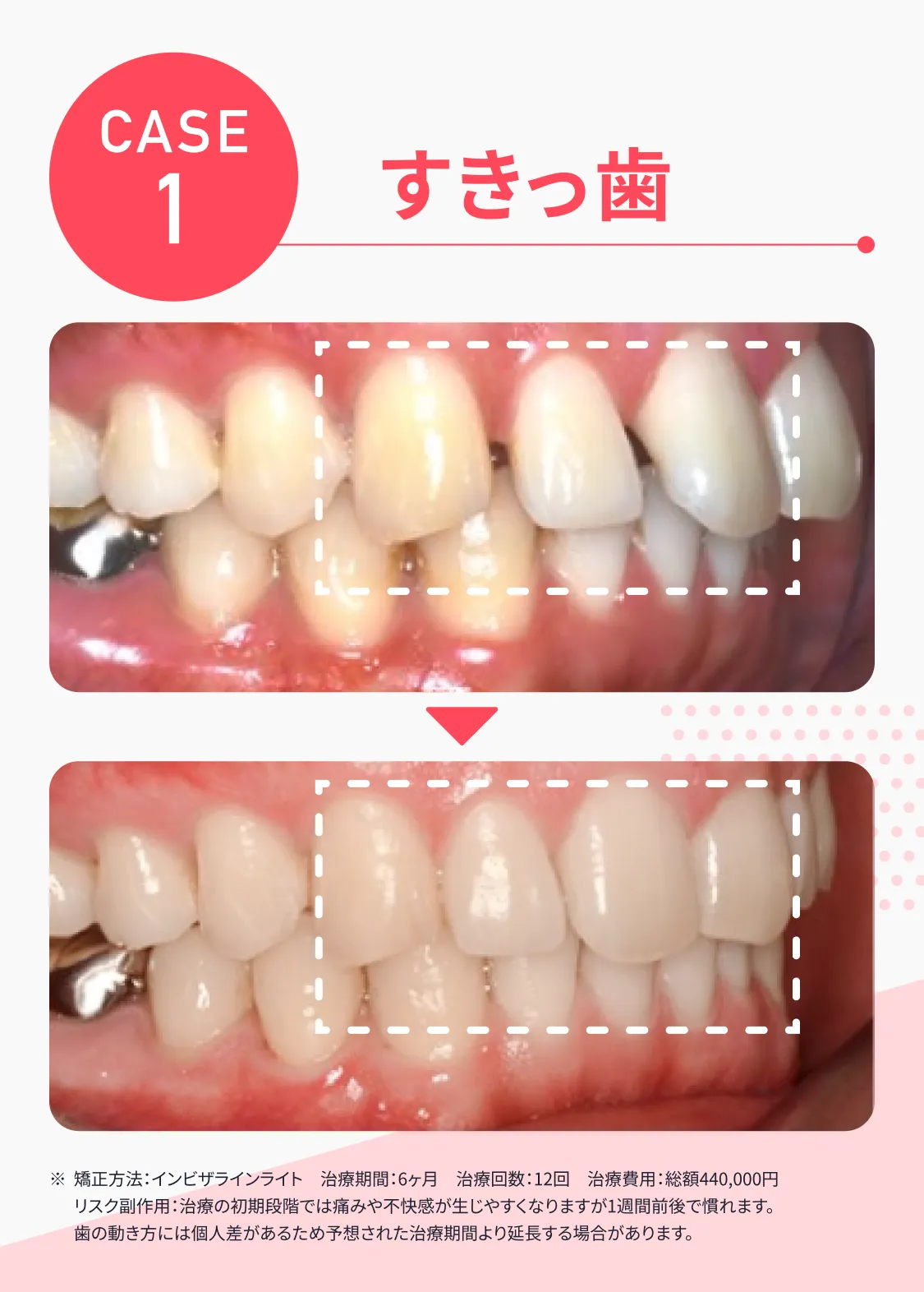 CASE1 すきっ歯