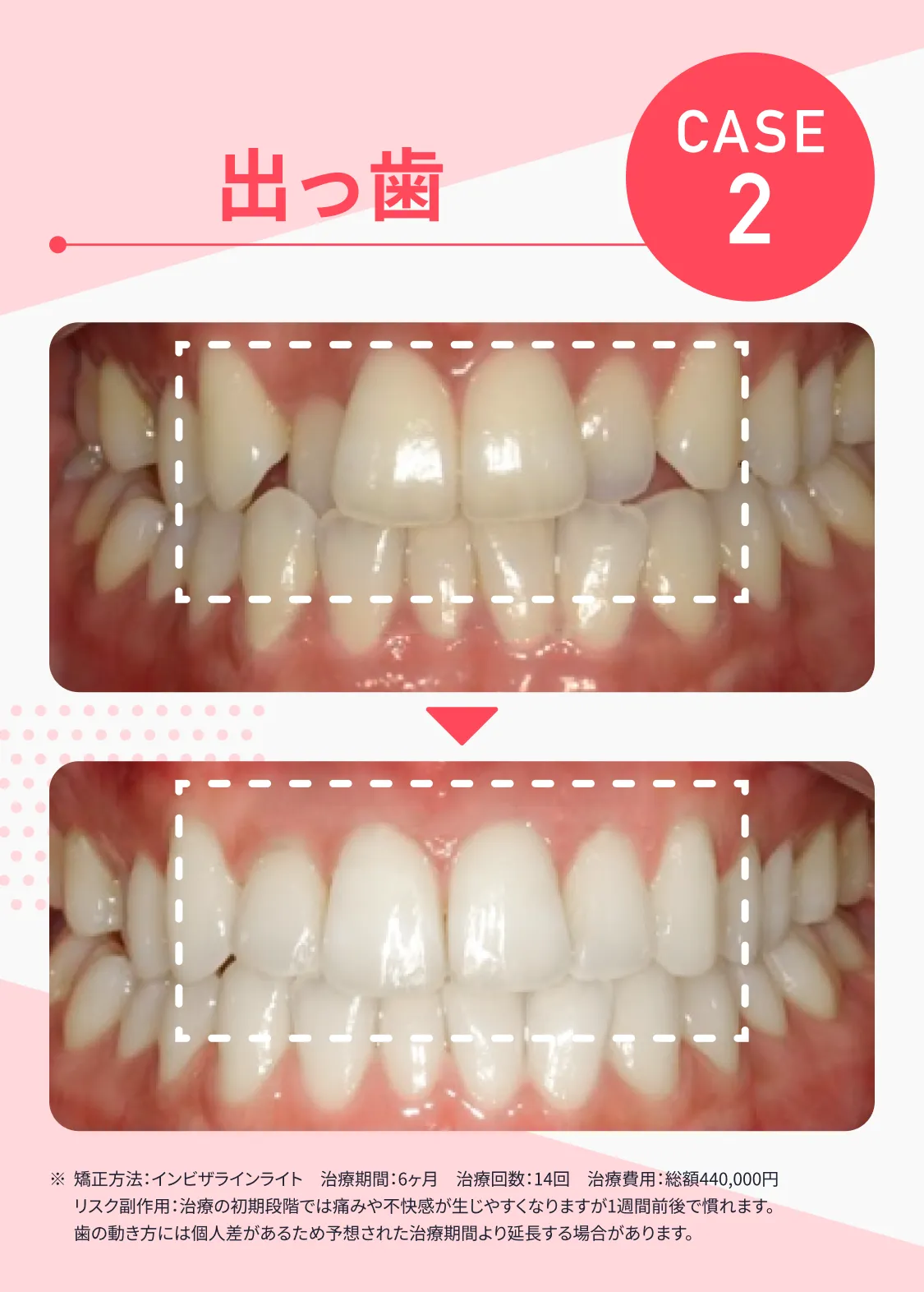 CASE2 出っ歯